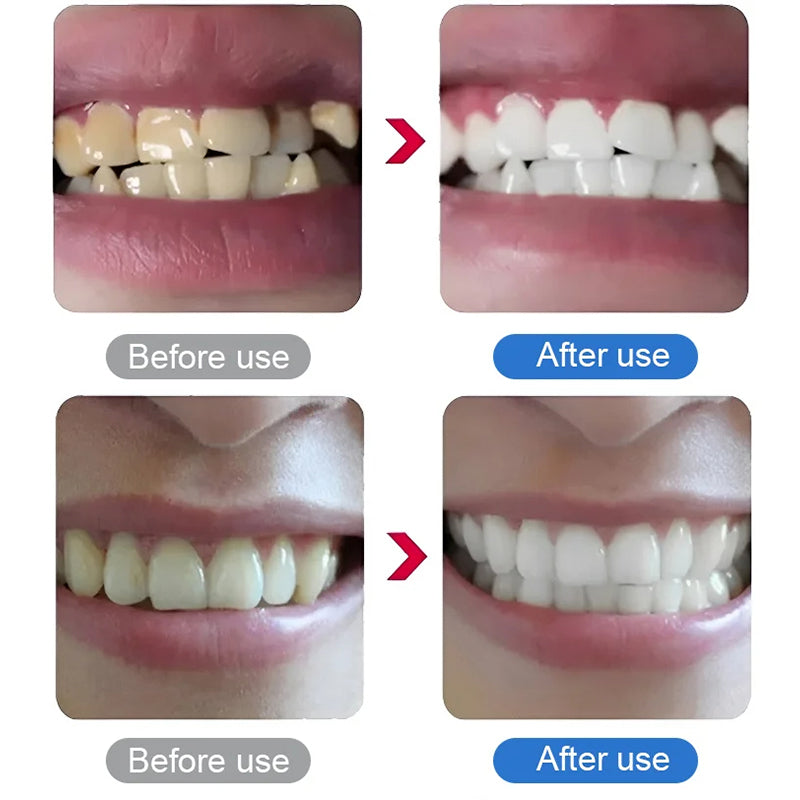 💎UP TO 30% OFF!!🦷✨Electric Ultrasonic Dental Scaler for Tartar and Plaque Removal