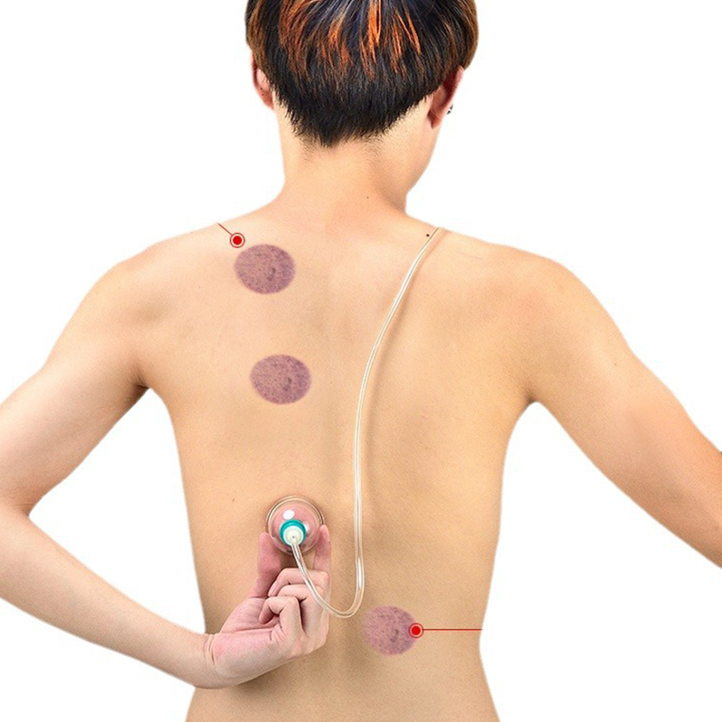 🧬 LIMITED-TIME 50% OFF! ✨ Vacuum Cupping Therapy Set – Thickened, Suction Pump, Transparent 🩺